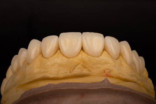 Carillas dentales