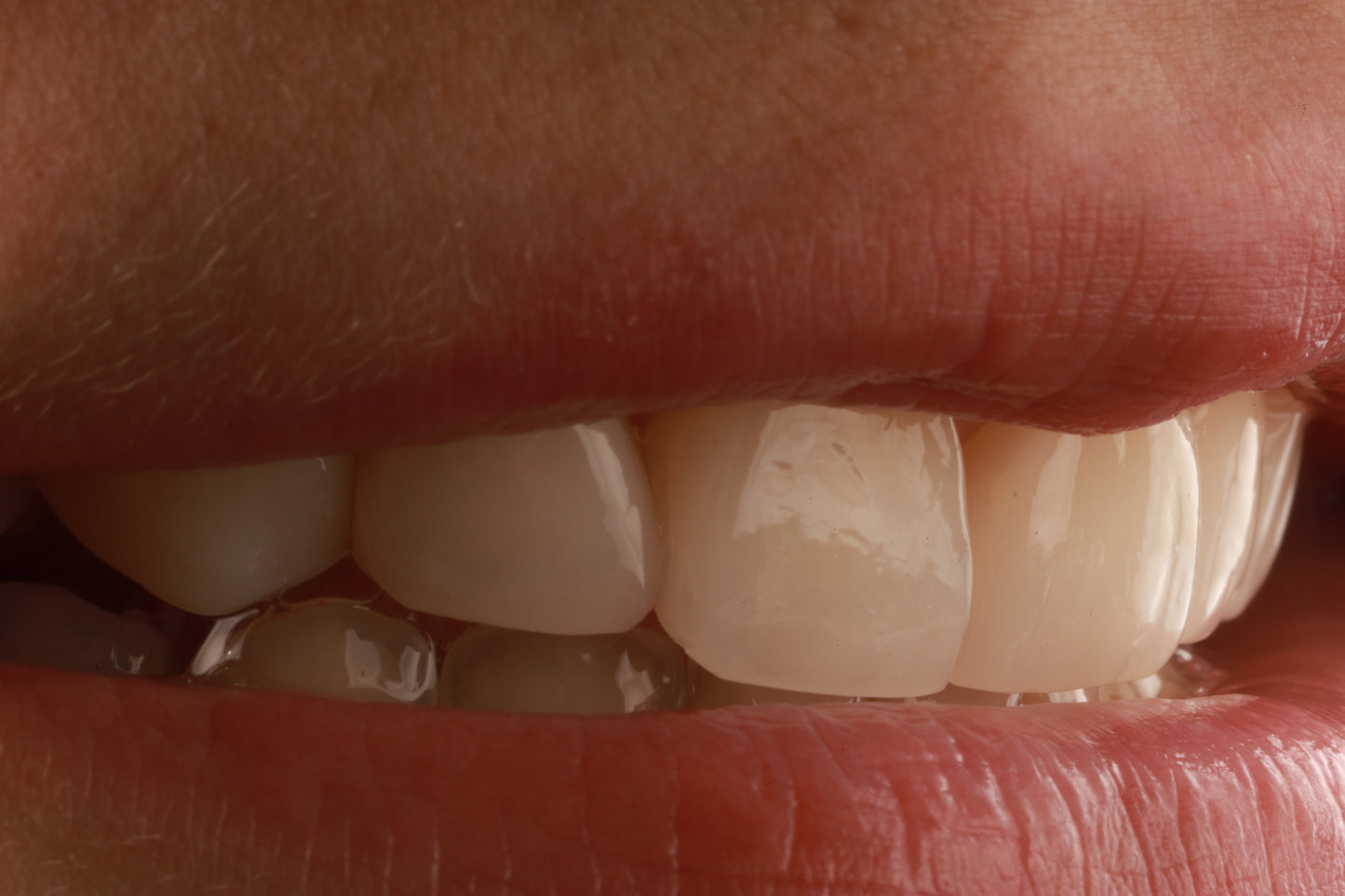 resinadental-resinas-restauraciondental-resinainyectada-drdanielcapetillo
