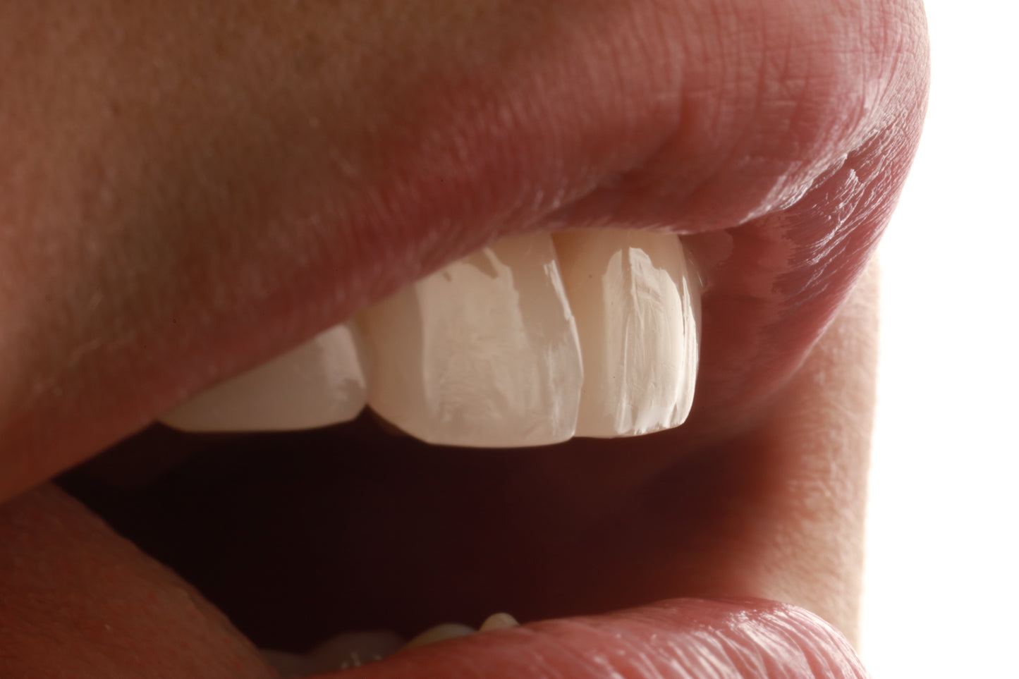 resinas-dentles-danielcapetillo-restauraciondental-carillasderesina
