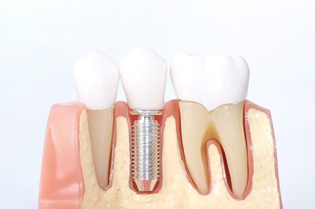 implantedental-protesisdentalimplantosoportada-implantesdentales-implantologia-mejoresimplantesdentales-cuantocuestaunimplantedental-drdanielcapetillo